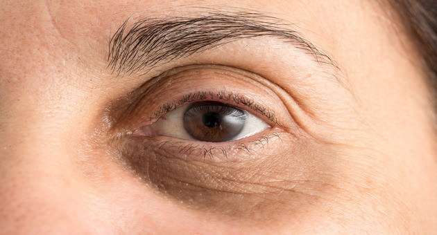 Under eye dark patch treatment 